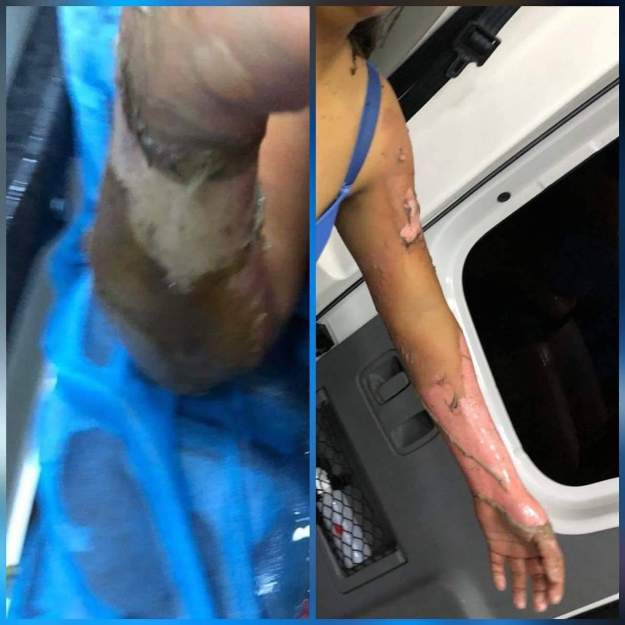 Dos niños quemados con pirotecnia en Temixco