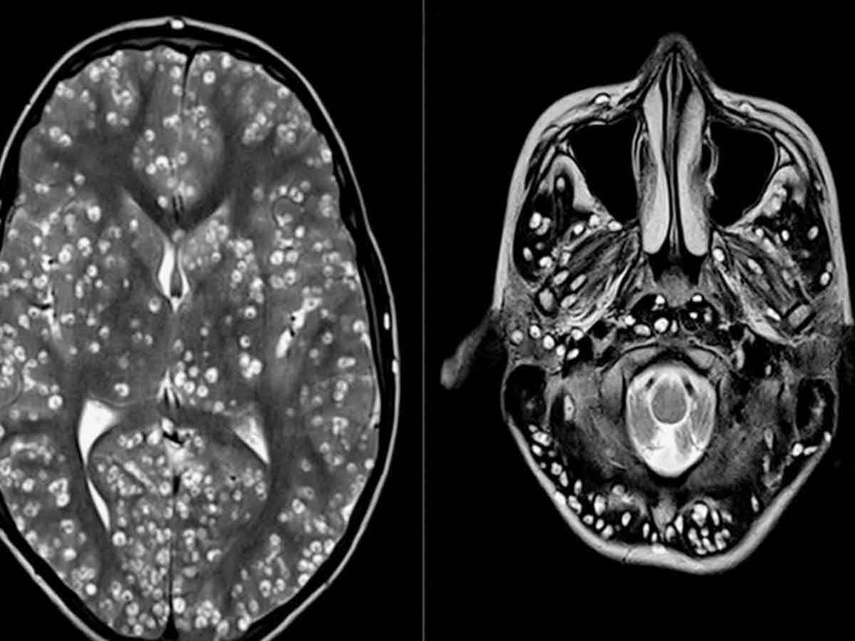 Sufría dolores de cabeza, su cerebro estaba lleno de larvas