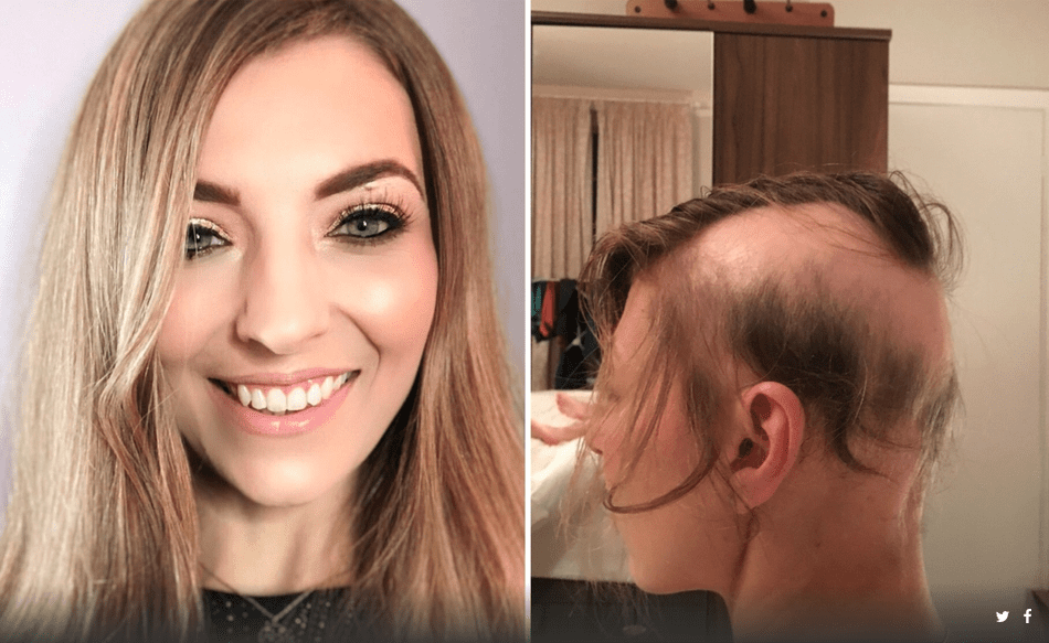 Días antes de su boda, Mujer perdió el 90 por ciento de su pelo por estrés.