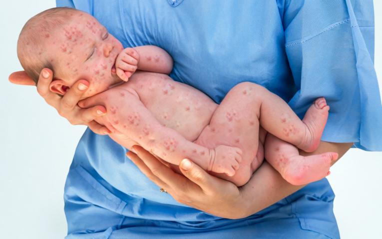Nueva York declara emergencia por epidemia de sarampión