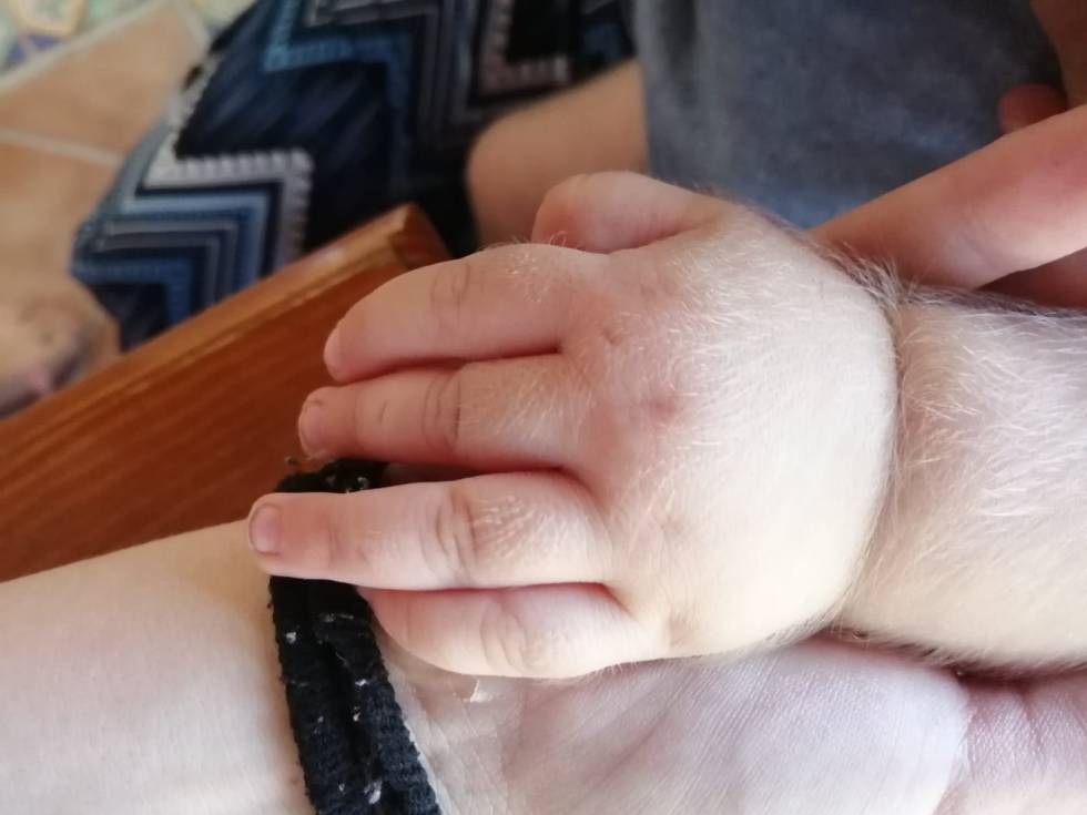 Bebés sufren “síndrome de hombre lobo” por error de farmacéutica