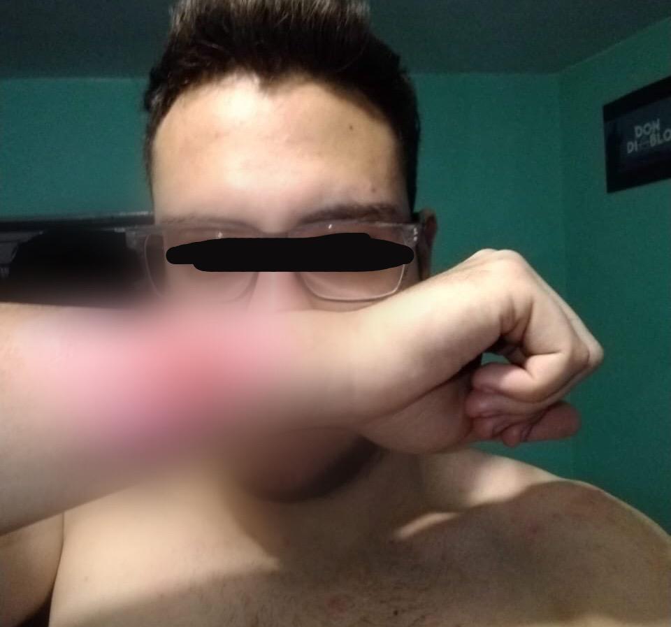 (FOTOS) Joven utiliza rayador de queso para quitarse tatuaje
