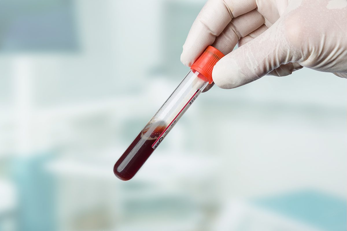 Sangre tipo A tiene más riesgo de contraer COVID-19 severo