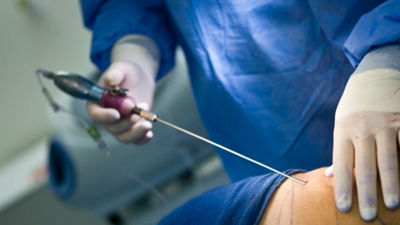 Muere joven de 23 años después de realizarse una liposucción