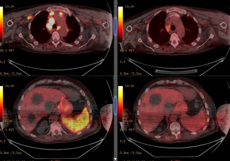 Hombre se curó del cáncer después de tener COVID-19, ya investigan el caso