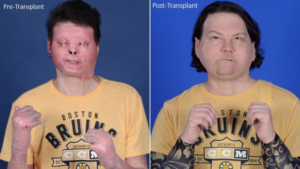 El primer trasplante de rostro y manos del mundo fue todo un éxito