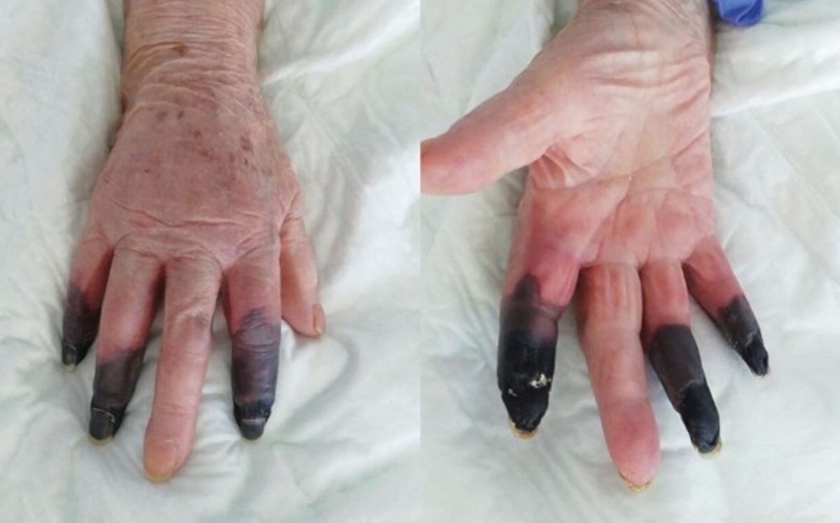 COVID-19 le provoca gangrena a una mujer de 86 años, tuvieron que amputarle 3 dedos