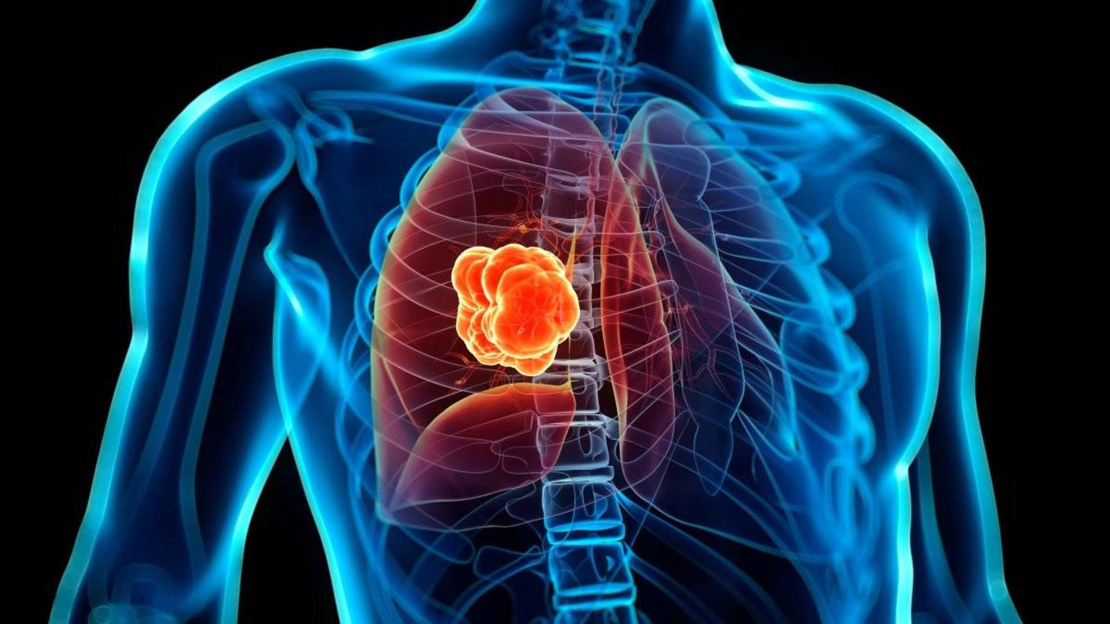 Científicos descubren nuevo tratamiento que podría combatir el cáncer de pulmón