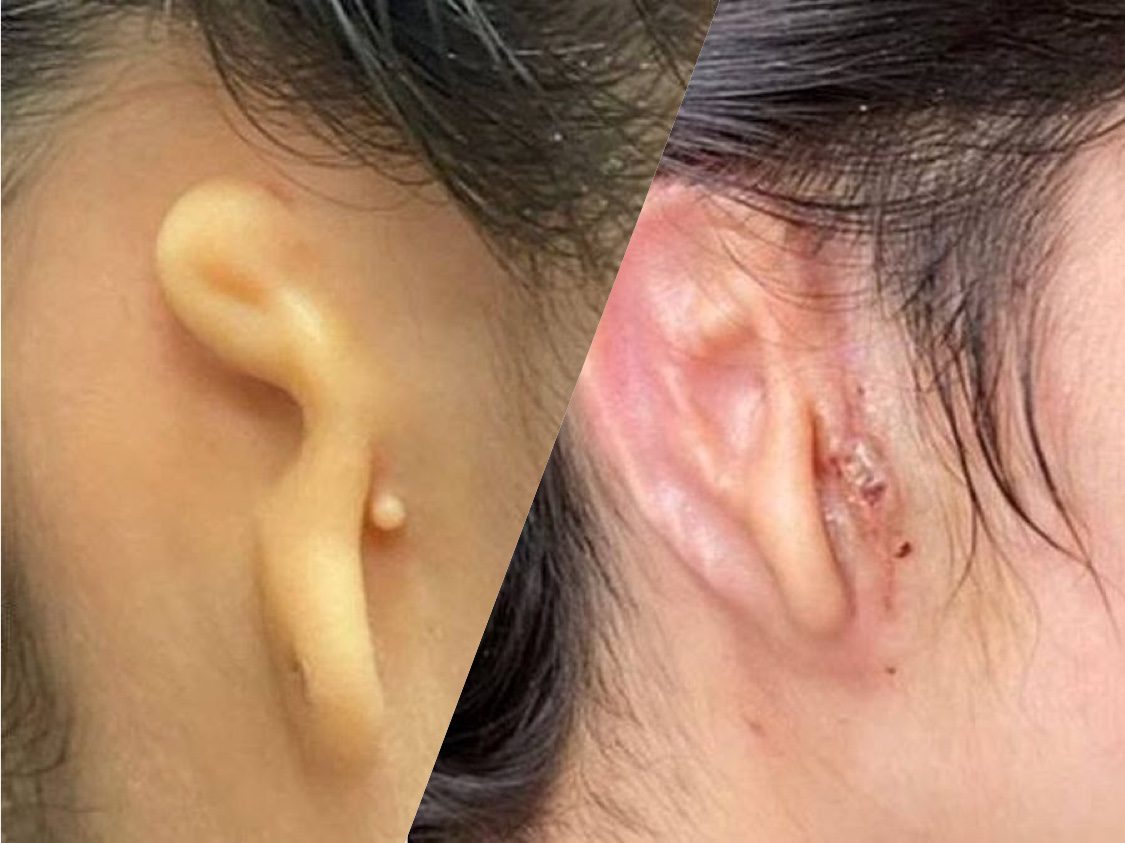 Realizan trasplante de oreja impresa en 3D a paciente mexicana en EEUU