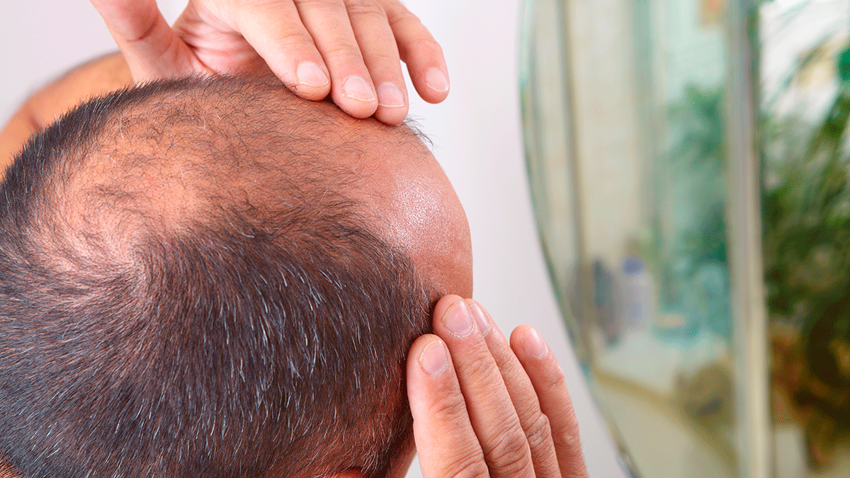 ¡Adiós calvicie! FDA aprueba tableta para tratar la alopecia areata