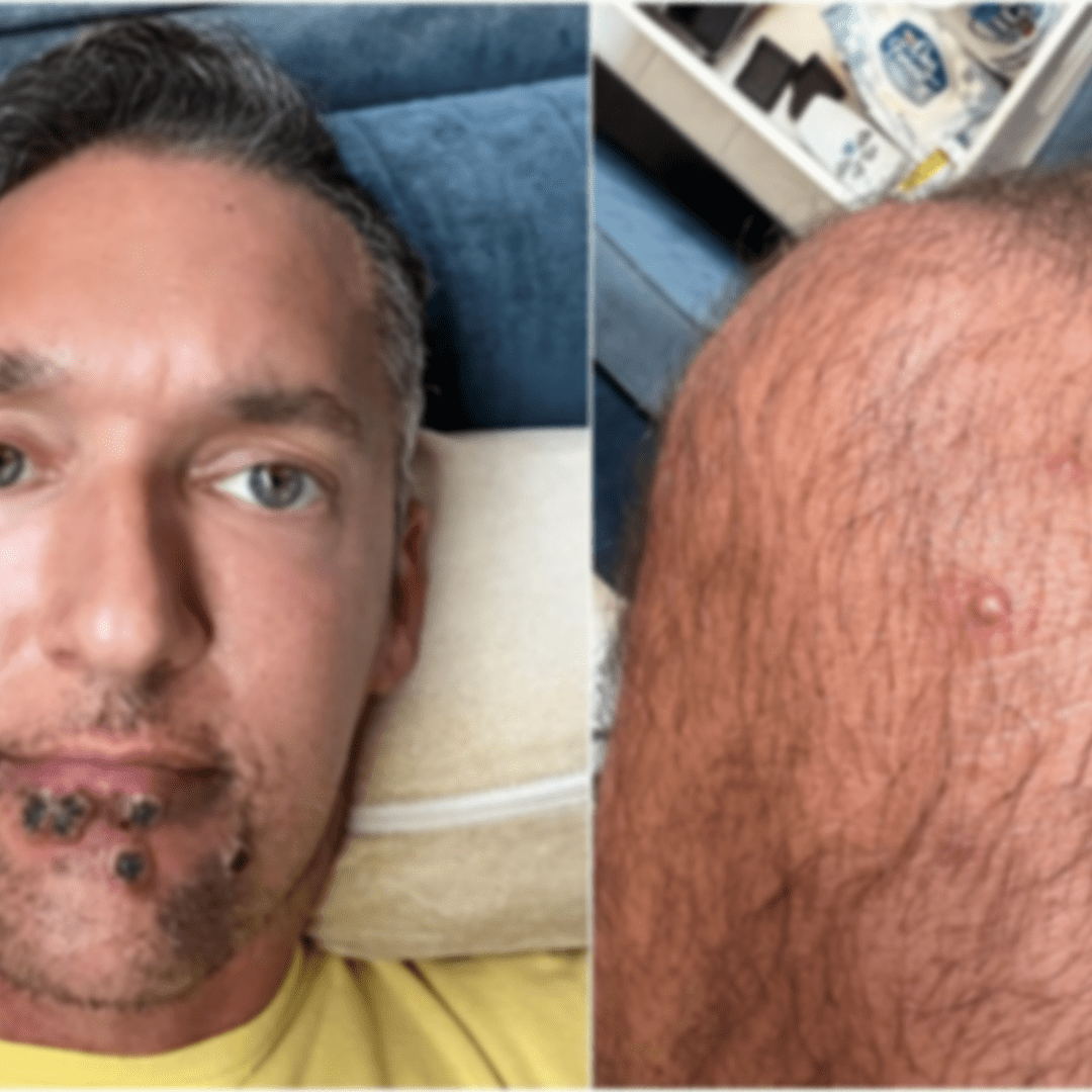 Actor 3X cuenta su experiencia tras contraer la Viruela del Mono