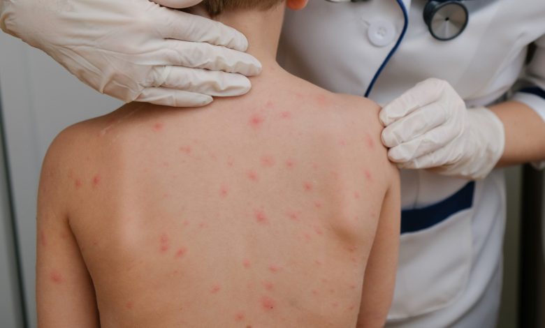 Gripe del tomate el nuevo virus que amenaza a los niños en India