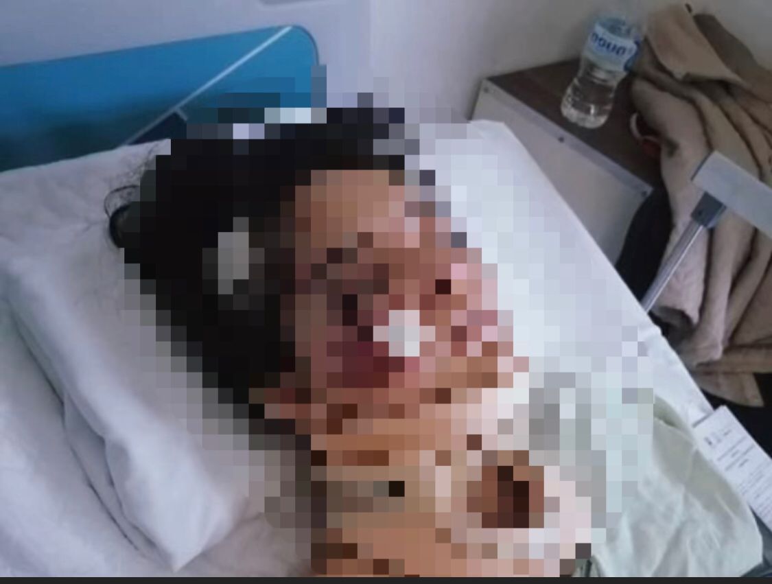 Solicitan ayuda para cubrir gastos médicos joven atropellada en la carretera México-Cuernavaca
