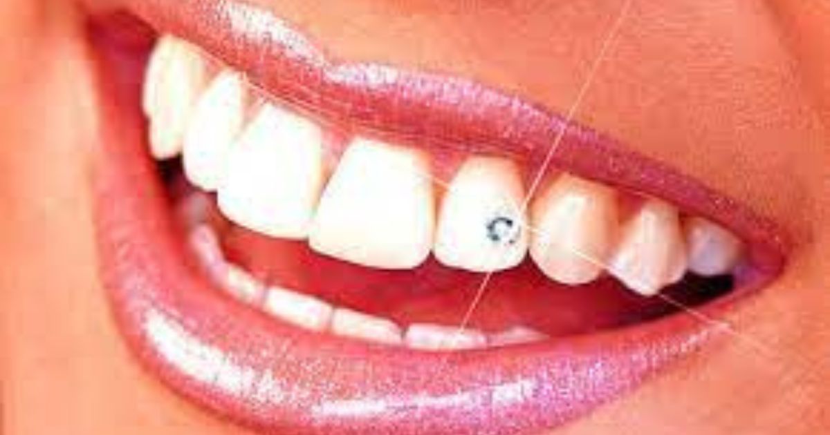 ¿Sabías que estos famosos tienen incrustación de diamantes en los dientes?