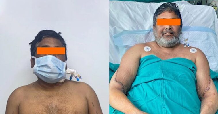 trasplante bilateral de extremidades