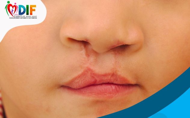 Cirugias gratuitas labio
