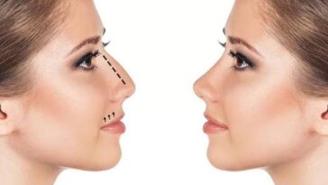 Quinceañera pide rinoplastía y termina con daño cerebral