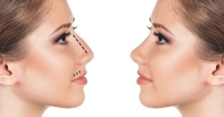 Quinceañera pide rinoplastía y termina con daño cerebral