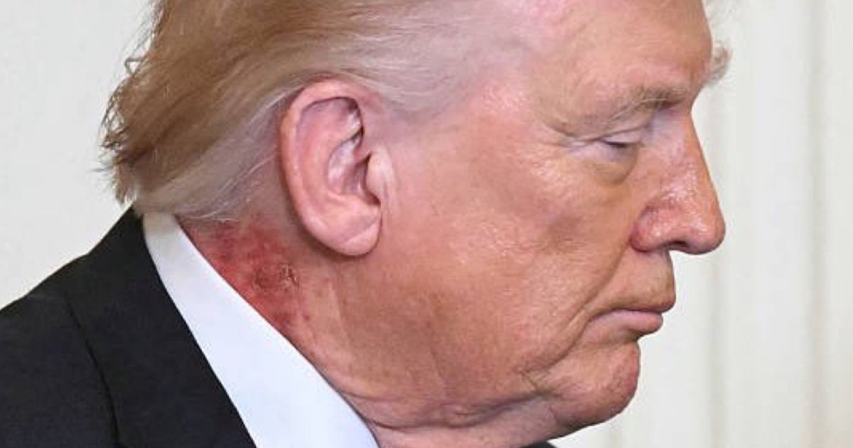 Captan sarpullido en el cuello de Donald Trump